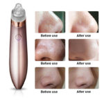 Blackhead Vacuum Remover – Strong Suction & Pore Cleaner for Clear Skin - Image 4